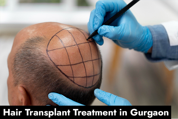 Hair Transplant Treatment in Gurgaon